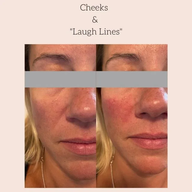 laugh lines covered with dermal filler