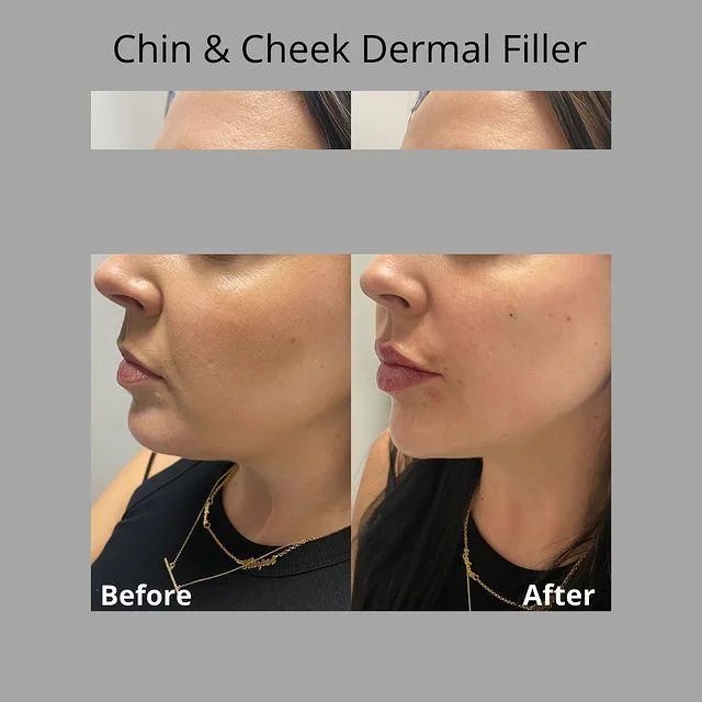 chin & cheek dermal filler treatment