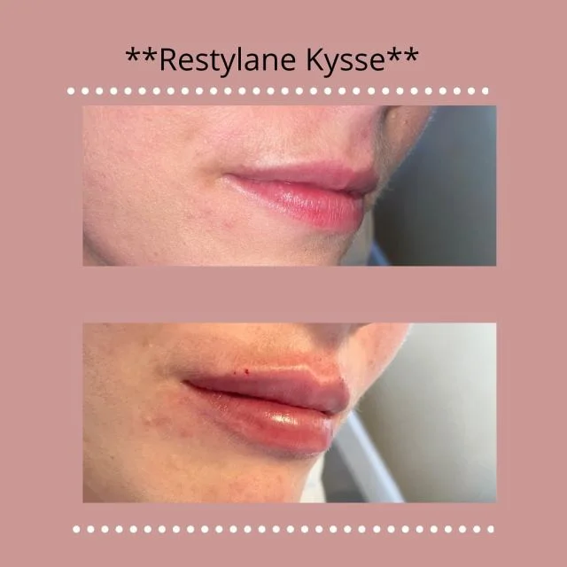 restylane kysse treatment on woman lips