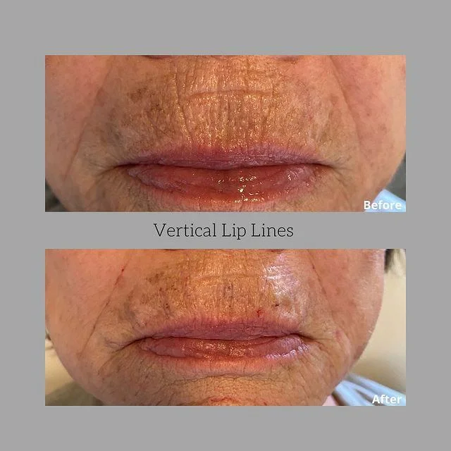 vertical lip lines treatment results