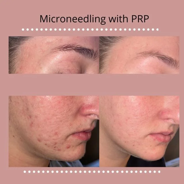microneedling with prp results on a young patient