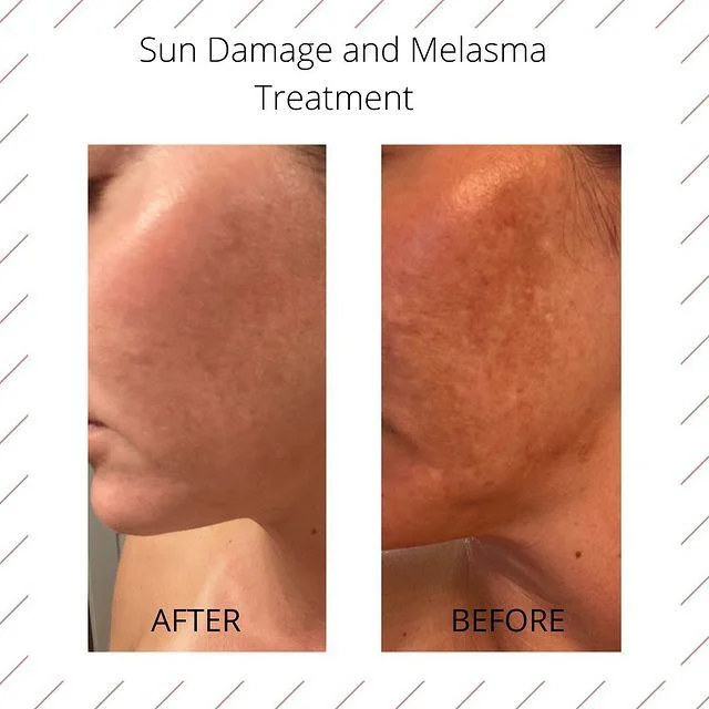 melasma and sun damage treatment results